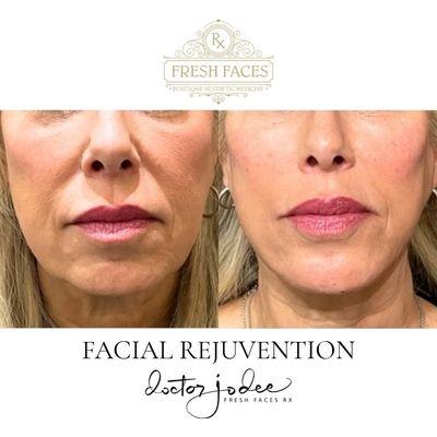 Treatment with hyaluronic acid-based dermal fillers to lift the patient's mid-face, blur nasolabial folds, and sculpt their jawline.