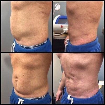 Vaser Lipo Before & After