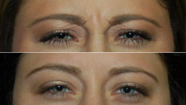 One week after botulinum toxin injection for frown lines or "elevens", with a smoother & less angry appearance.