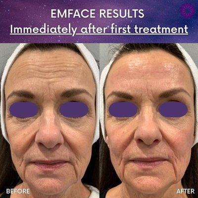 EMFACE Results! How Incredible!