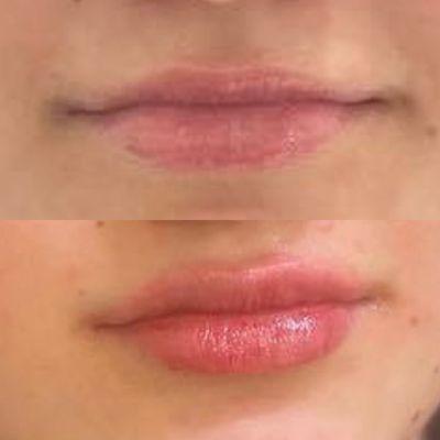 #juvaderm #lipfillers #rosevilleaesthetics