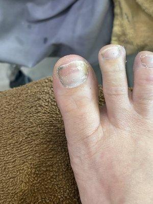 Toe fungus under both big toe nails