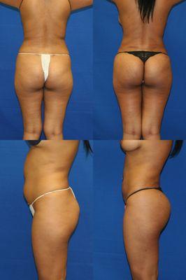 Brazilian Butt Lift (Liposculpting with Fat Transfer to Buttocks)