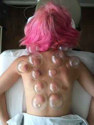 Cupping