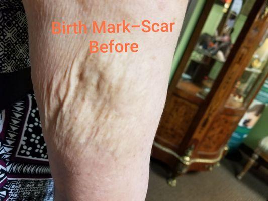 Scar Treatment for Birth Mark