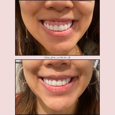 Gummy smile correction with botox.