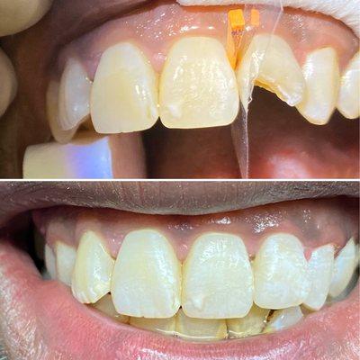 Chipped Tooth! Easy Fix! Don't wait get it done today!