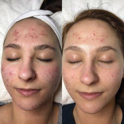 Clear skin program, 4 weeks apart. Holistic approach.