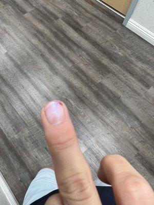 Damaged nail