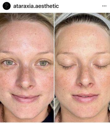 Before & After Dermaplane