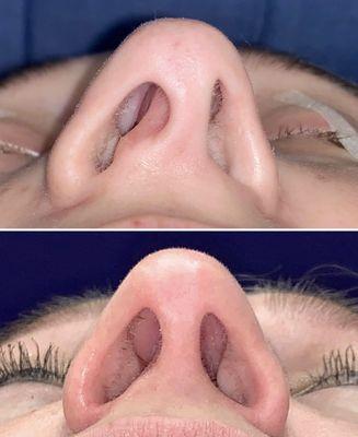 Close rhinoplasty performed for nasal blockage & crooked nostrils. She has open nasal passages & improved nostril symmetry 6mos after.