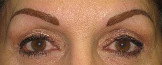 Newly completed permanent eyebrows.