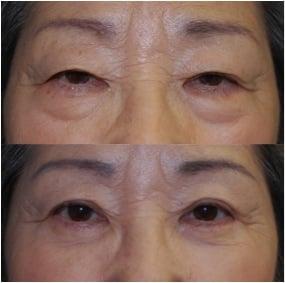 upper and lower eyelid blepharoplasty and ptosis repair