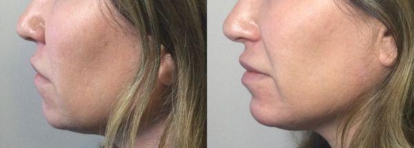 Chin augmentation with fillers.