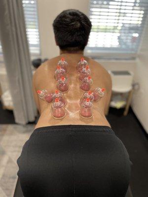 Cupping with Active Mobilization to Mid- & Lower Back