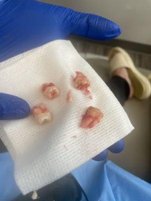 Wisdom tooth extraction!