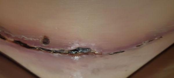 Botched tummy tuck