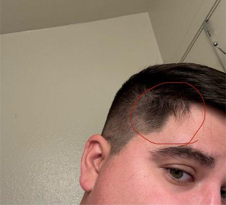 Clump of hair left on both sides of my head