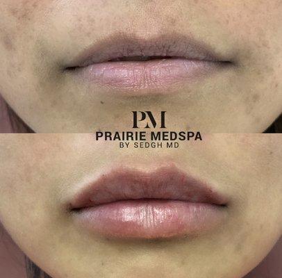 Lip enhancement at Prairie Medical Spa