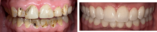 Extensive decay was controlled and ALL teeth were restored with porcelain crowns while preventing the need for any root canals.