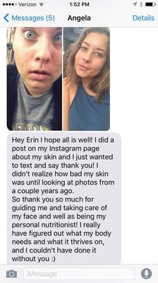 Acne treatments resulting in a thank you text from a great client