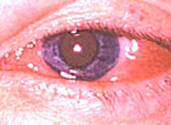 Epidemic keratoconjunctivitis diagnosed & treated by Master Eye doctors.