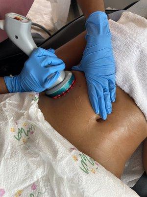 Ultrasonic Cavitation- Eliminates targeted fat cells