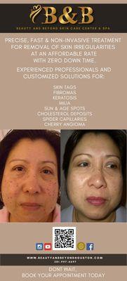 Skin irregularities removal @ B&B