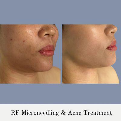 RF Microneedling & Acne Treatment