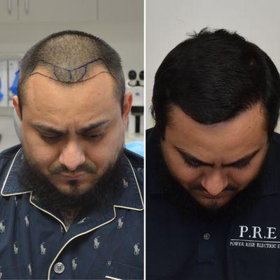 Only 6 months post FUE Hair Restoration at 50% growth. Double density still to come following next 10 months.