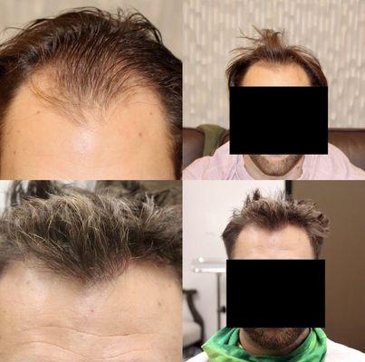 Patient underwent a 1766 graft FUE procedure to reconstruct the hairline and add more density.