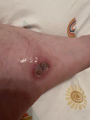 A close up of the infected foot and it was swollen.