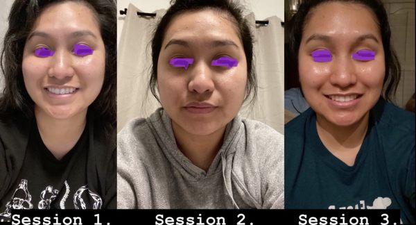 Notice the cheeks and how bloated my face was in session 1 vs session 3!