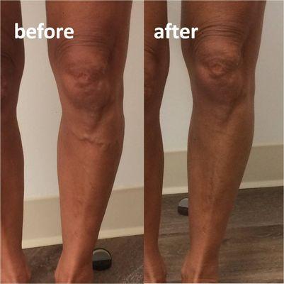 varicose vein removal