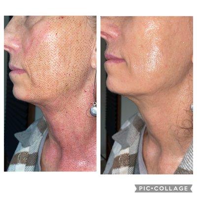 Plasma Pen full neck lift