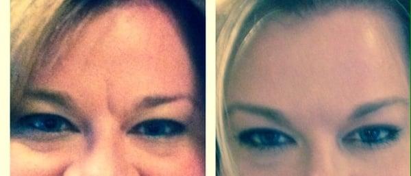 Before and after Dysport and Restylane!