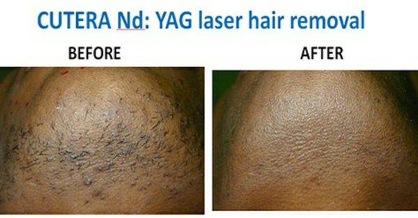 Laser hair removal helps men with their ingrown hair problems!