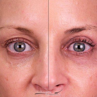 Upper blepharoplasty - eyelid surgery