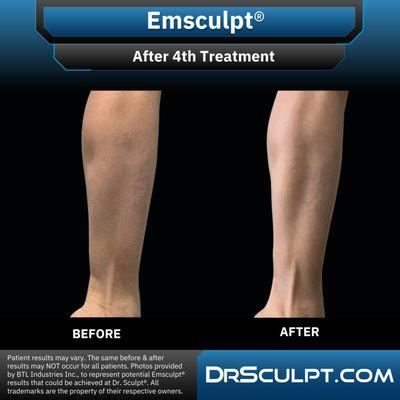 After 4th CoolSculpting treatment on calves