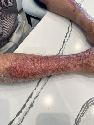 2nd degree burns that this man did not recognize after the treatment this man recommended.