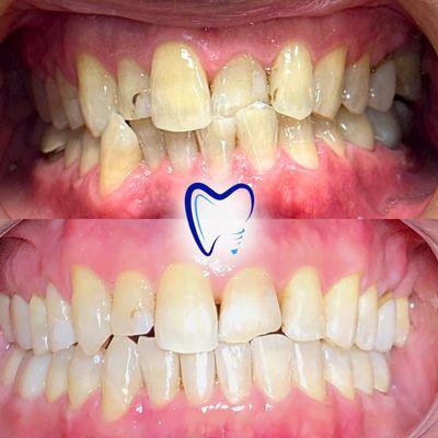 Here we can see another example of orthodontic (teeth straightening results) with us at Honda Plaza Dental!