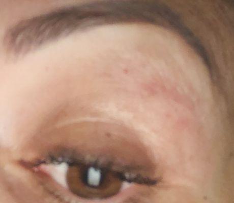 Chewed up under my brows. Painful threading