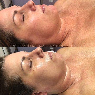 Before|After DMK enzyme therapy