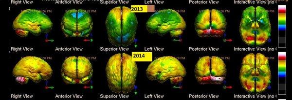 SPECT brain scan of patient with Chronic Fatigue Syndrome before (top row) and after (bottom row) treatment.