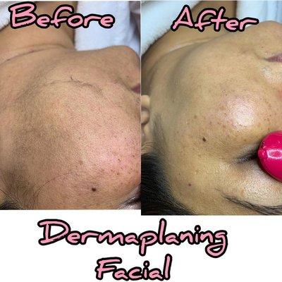 Dermaplaning