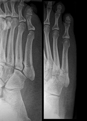 Jones fracture.