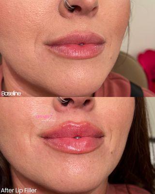 Before and after one syringe of lip filler.