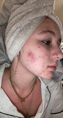 Acne before Acne treatments.