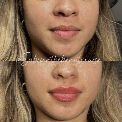 Lip filler by Sabrina MSN, FNP-C