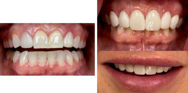 Patient desired veneers on the front 8 teeth to improve shape and color.